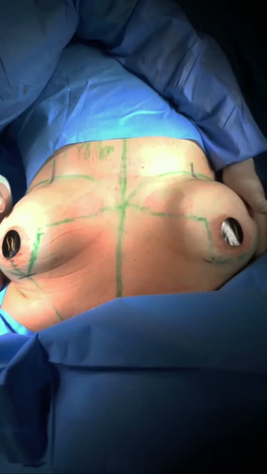 Mommy Makeover: Mama, Abdômen e Lipo